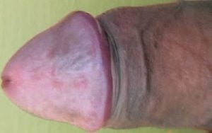 bruised penis injury