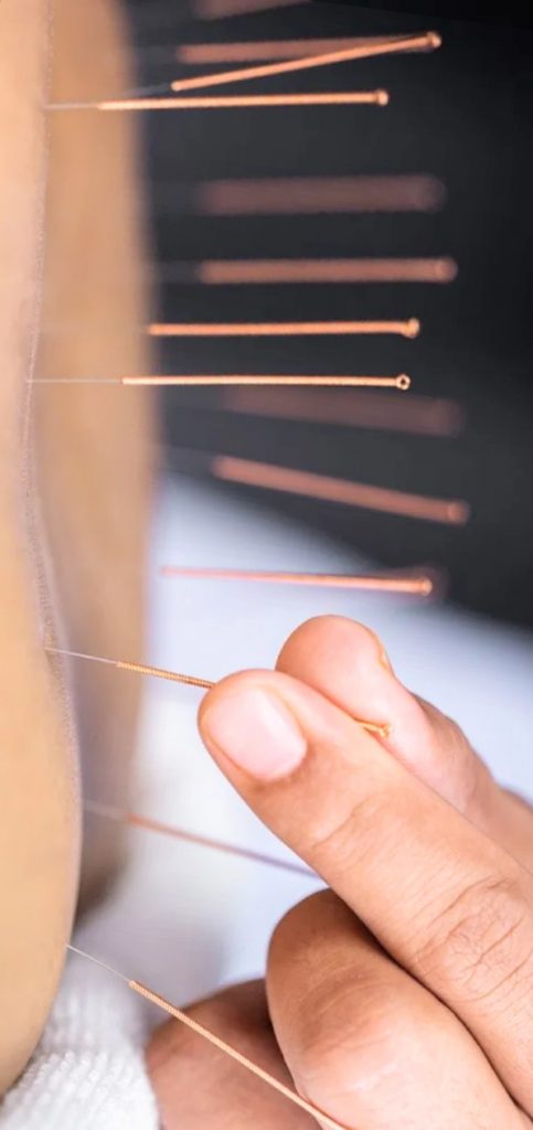 acupuncture procedure for men